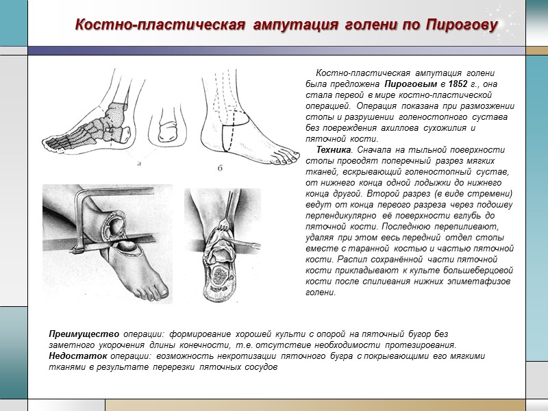 Костно-пластическая ампутация голени по Пирогову Костно-пластическая ампутация голени была предложена Пироговым в 1852 г.,